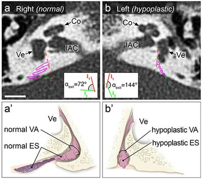 Radiological Configuration of the Vestibular Aqueduct Predicts Bilateral Progression in Meniere's Disease